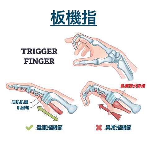 手指腫脹無法彎曲|板機指看哪一科？會自己好嗎？症狀、原因和治療一次。